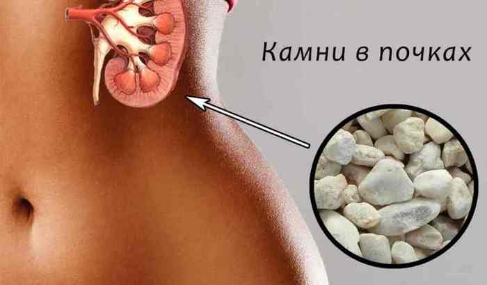 марена красильная от камней в почках