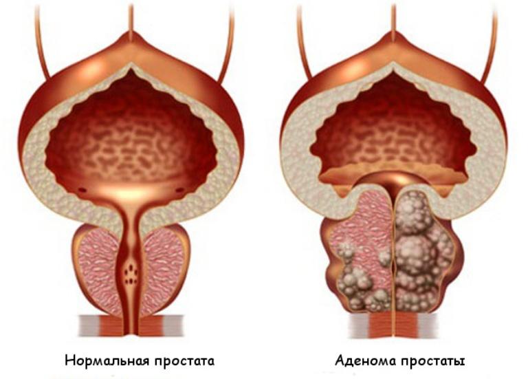 Аденома простаты